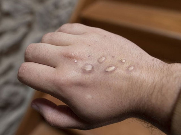 2687959 monkeypox 1724000332