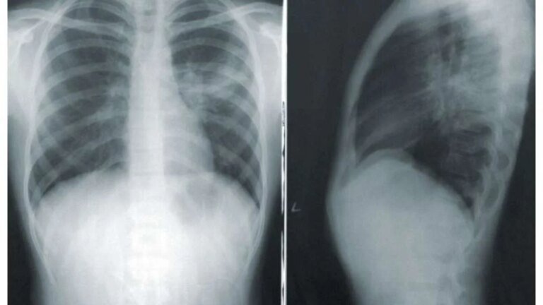 Lung cancer radiation study reveals surprising quality of life benefits