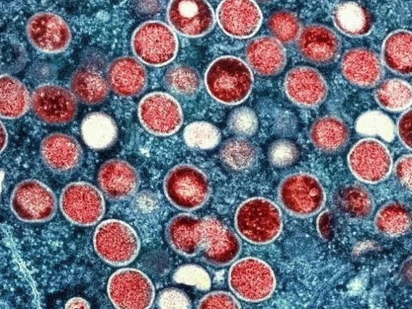 First human case of new mpox virus detected in Bri1730548616 0