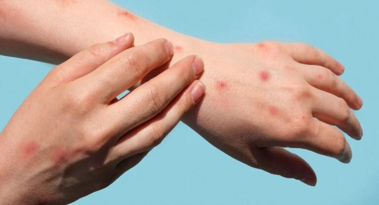 Karachi reports new monkeypox case