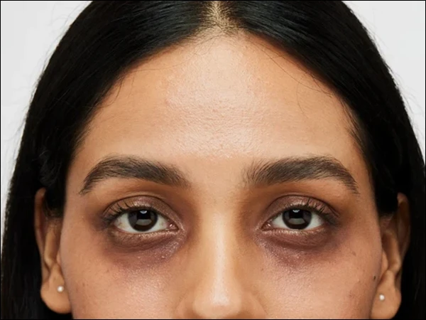 dark circles1793282094 0