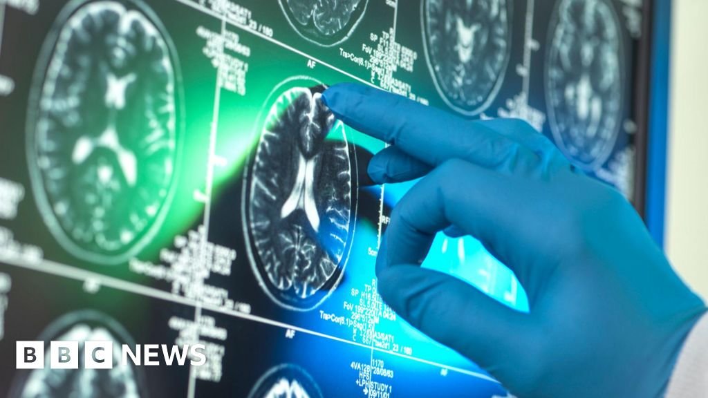 Breakthrough Alzheimers drugs unlikely to benefit patients, report suggests 10 'Breakthrough' Alzheimer's drugs unlikely to benefit patients, report suggests