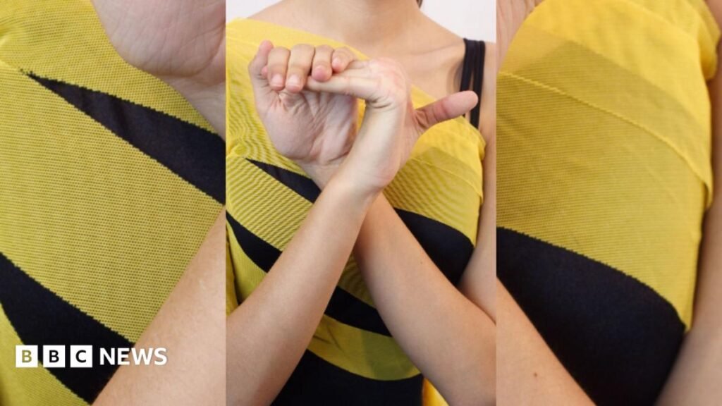 What are the symptoms of Hypermobility Spectrum Disorder? 10 What are the symptoms of Hypermobility Spectrum Disorder?