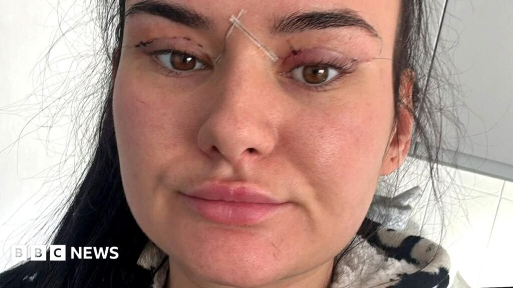 Open wounds and eyes that cant close - women warn about cheap bleph eyelid surgery 10 Open wounds and eyes that can't close - women warn about cheap bleph eyelid surgery